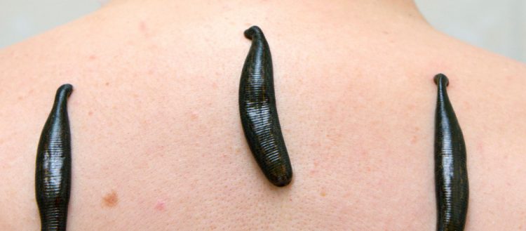 L'usage des sangsues médicinales